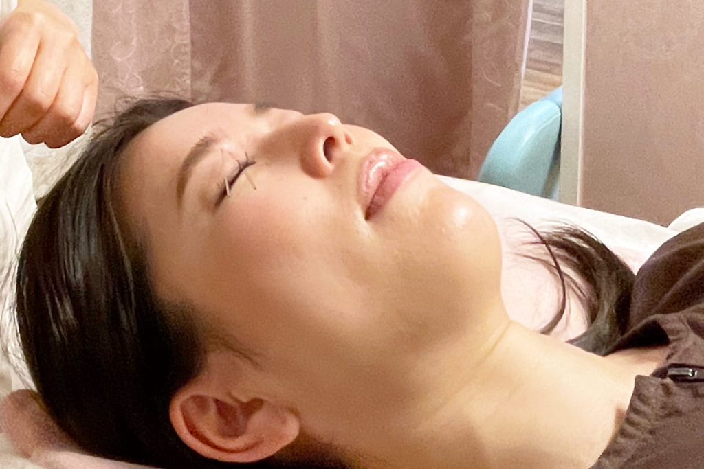 目のまわりの鍼