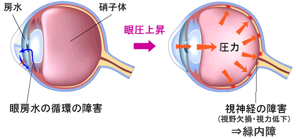 高眼圧緑内障のイメージ