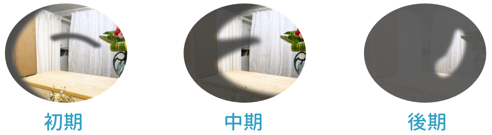 視野欠損・狭窄のイメージ：初期～後期