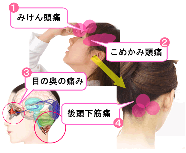 スマホ眼痛 スマホ頭痛の鍼治療 東京都の板橋駅前オアシス鍼灸院
